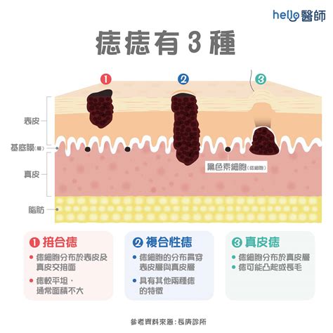 臉上的痣|痣形成的原因？痣長毛、痣變多變大是痣病變？5招判。